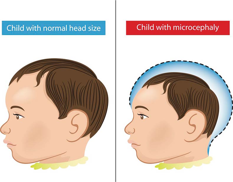 Microcephaly