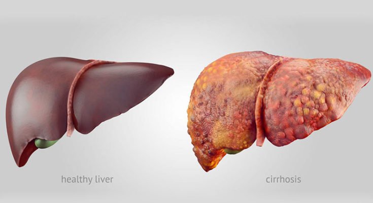 Astrological Analysis of Liver Diseases, Prostate Cancer & Renal Failure