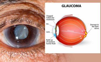 Astrological analysis of Glaucoma