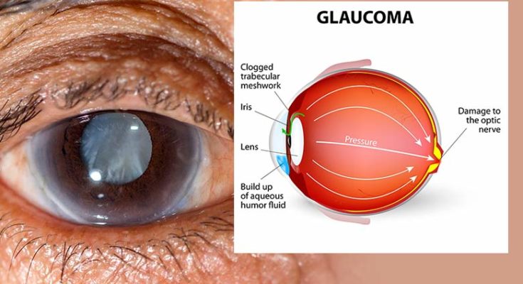 Astrological analysis of Glaucoma