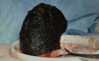 British doctors removed giant hairball from a woman's stomach