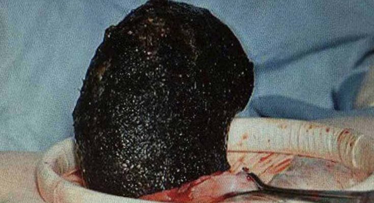 British doctors removed giant hairball from a woman's stomach