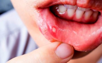 Know about mouth ulcer – its causes and remedies