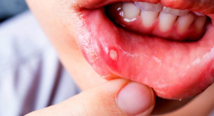 Know about mouth ulcer – its causes and remedies