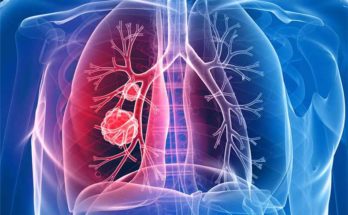 Lung cancer rates are much higher in women