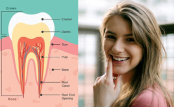 Modern way of tooth engineering with remineralization