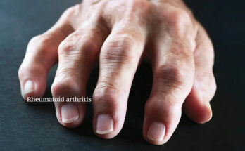 How dangerous Rheumatoid Arthritis is