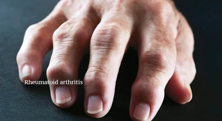 How dangerous Rheumatoid Arthritis is