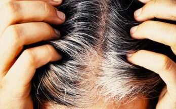 How to cure premature grey hair?