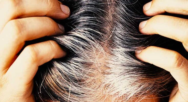 How to cure premature grey hair?